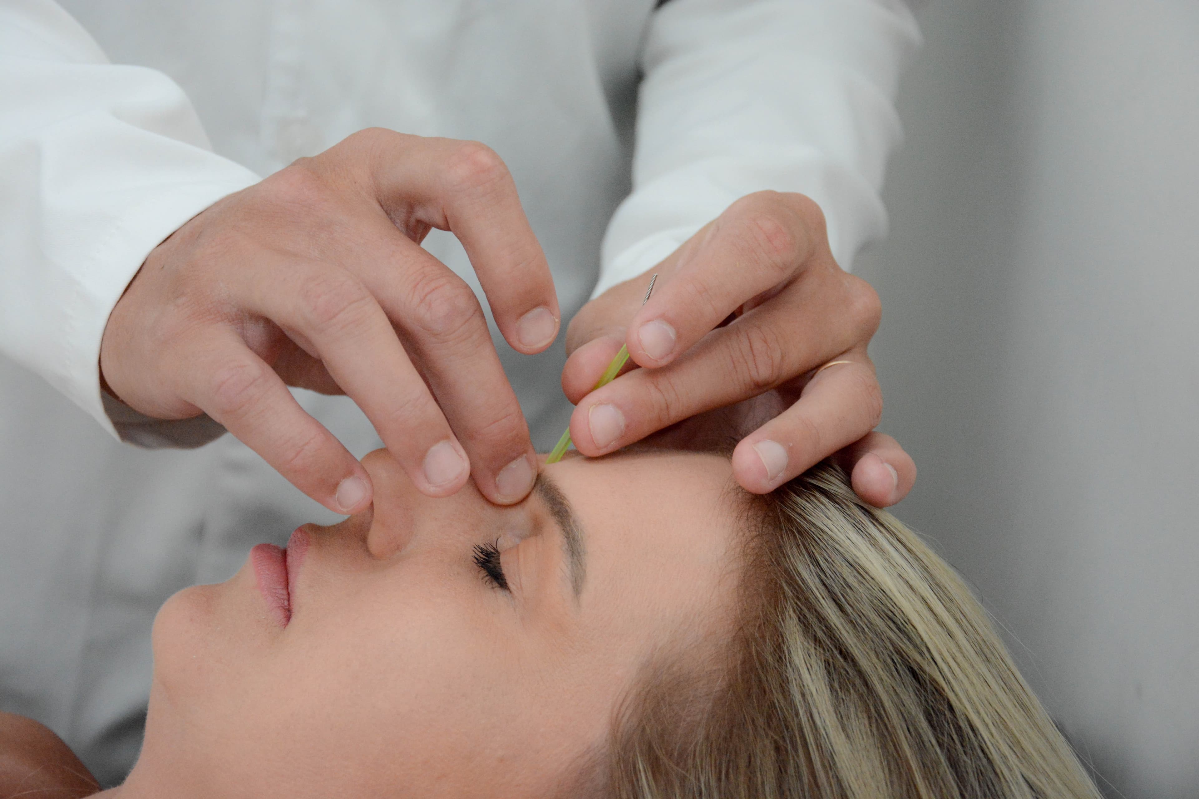 Agulhas de acupuntura aplicadas nas costas de uma pessoa